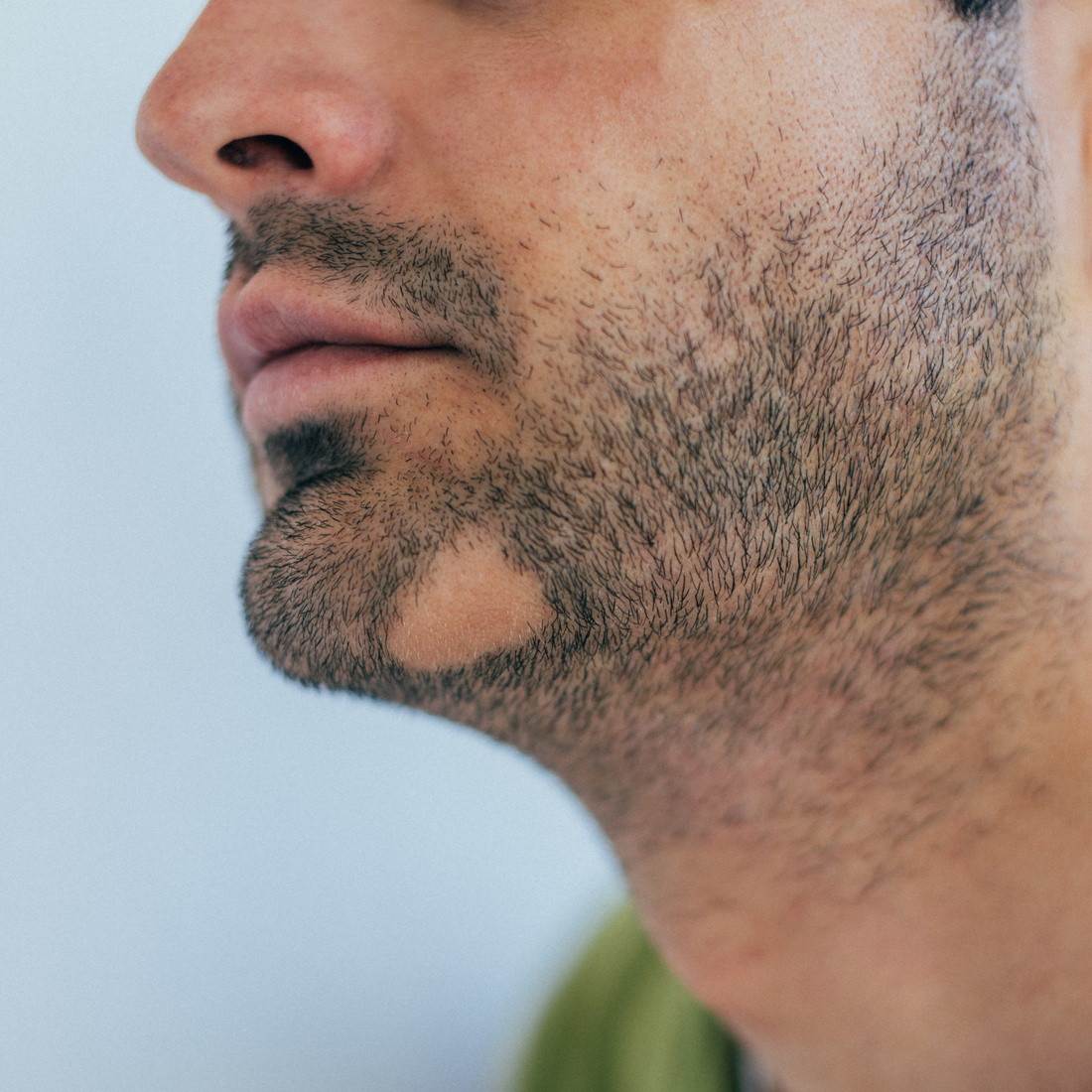 Alopesi Areata(Sakal kıran) Destek Seti