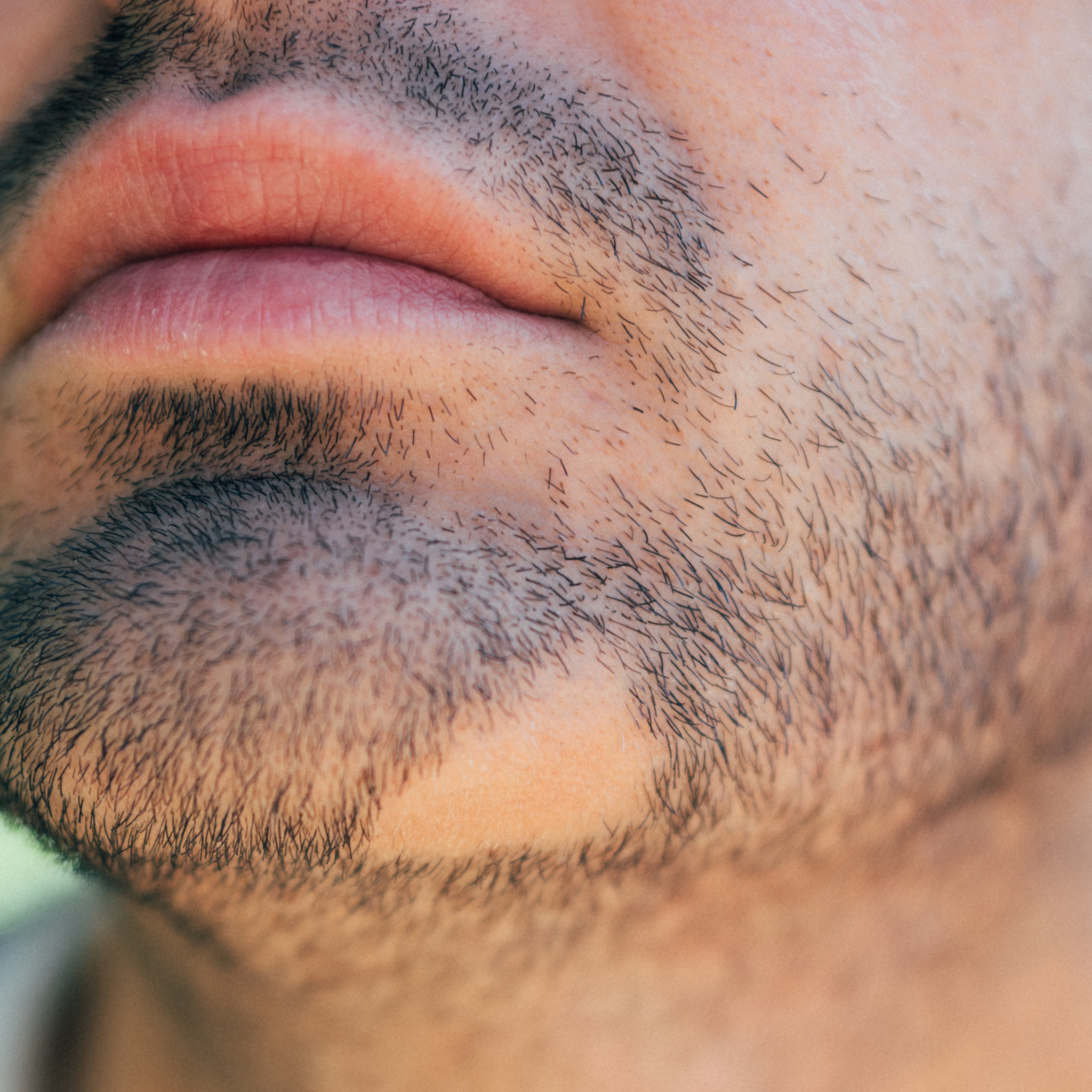 Alopesi Areata(Sakal kıran) Destek Seti