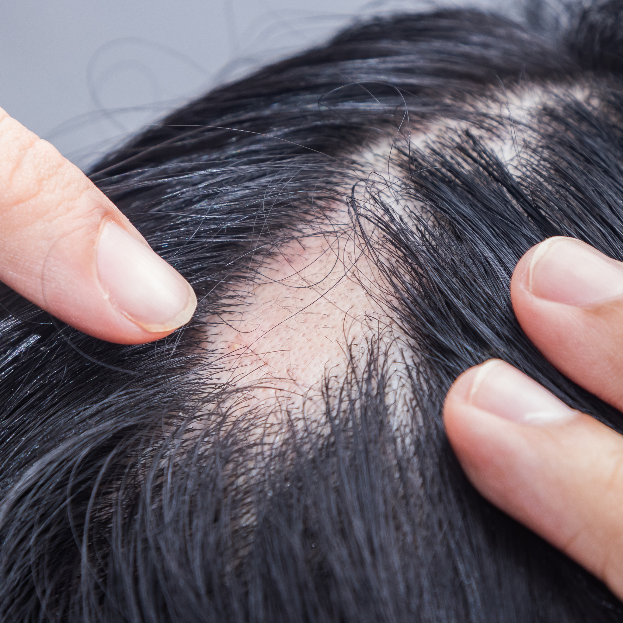 Alopesi Areata(Saçkıran) Destek Seti
