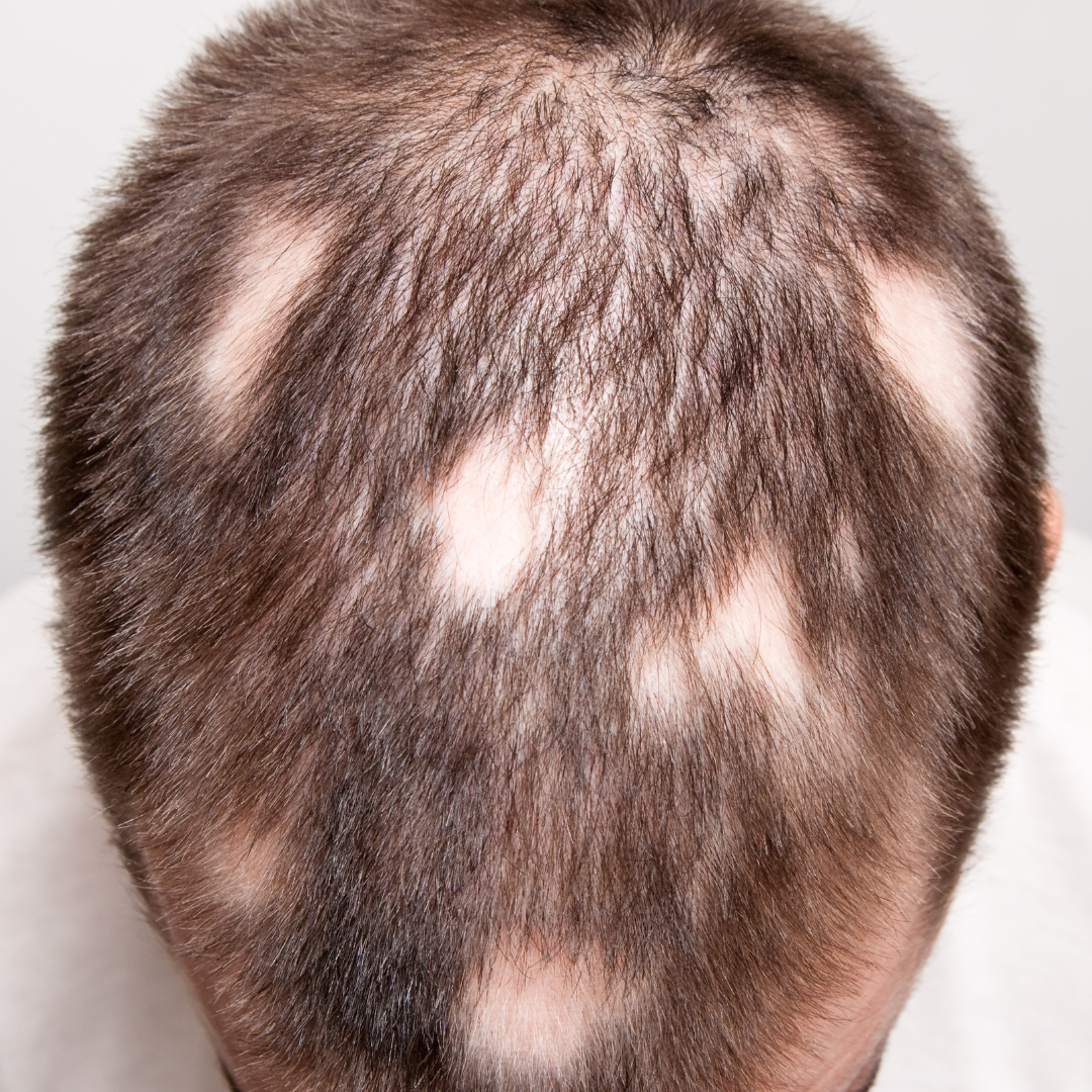 Alopesi Areata(Saçkıran) Destek Seti